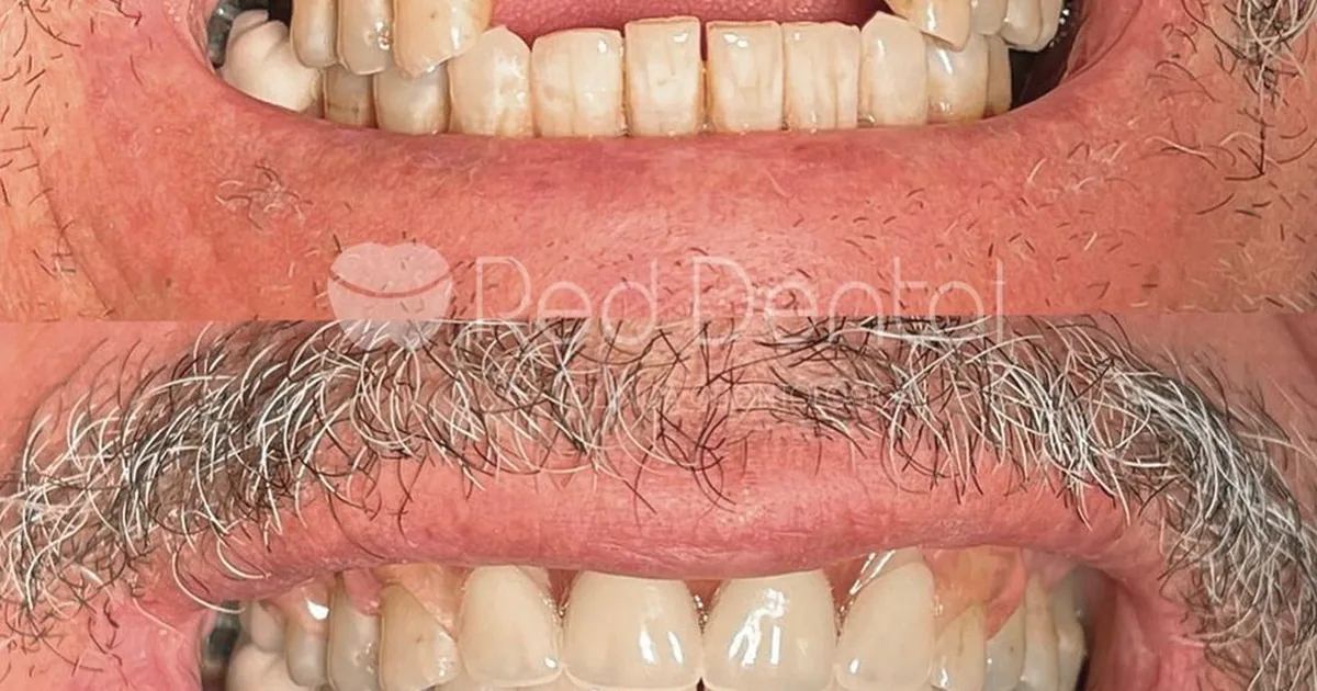 DENTAL ROJO