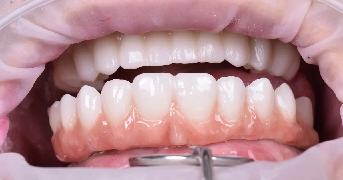 Enamelex Clinica Dental rosarito