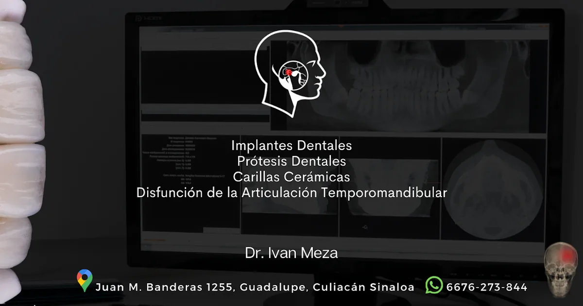 Implantes Dentales / Carillas Dentales / Dr. Ivan Meza