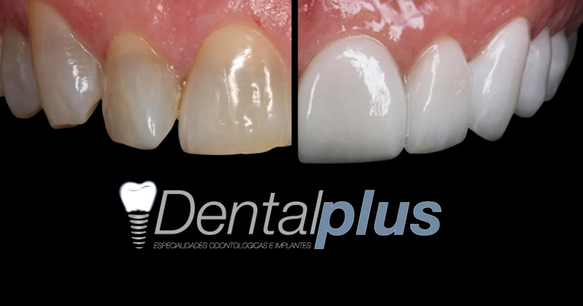 Dentalplus