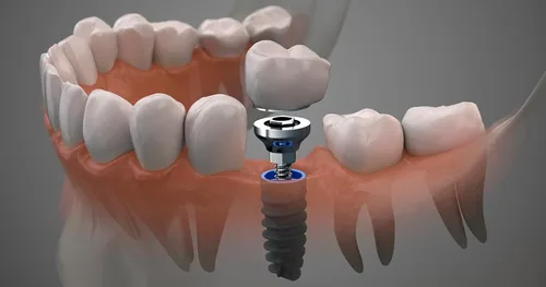 Dentista Urgencias / Brackets /Endodoncia/ Limpieza Dental Blanqueamiento Implantes Protesis Estetica, consultorio dental en Tlalpan, Ciudad de México