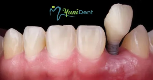 Yunident, consultorio dental en Manzanillo, Colima