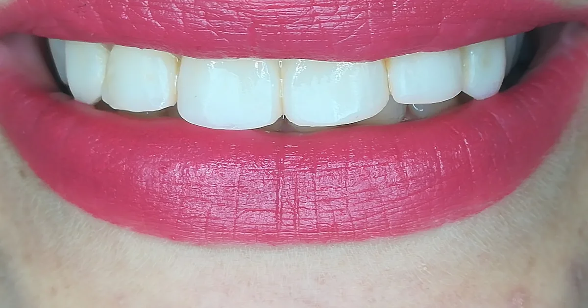 Dental Krysli