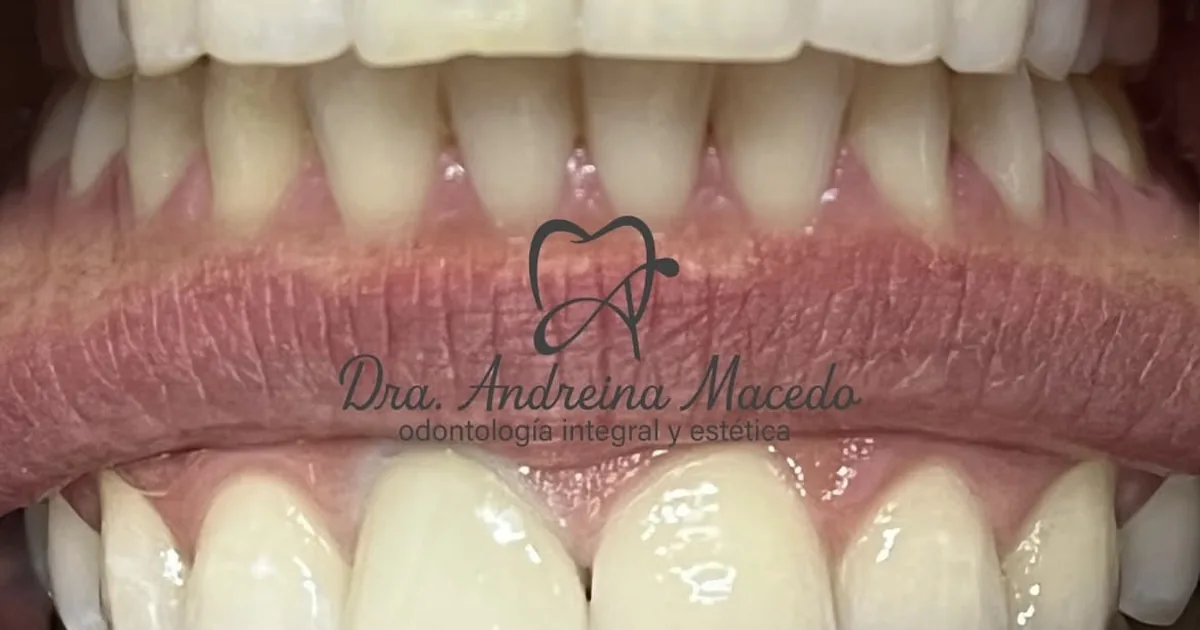 Dra. Andreina Macedo Dueñas Dentista en Col. 5 de diciembre , Puerto Vallarta, Jal.
