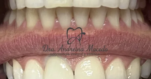 Dra. Andreina Macedo Dueñas Dentista en Col. 5 de diciembre , Puerto Vallarta, Jal., consultorio dental en Puerto Vallarta, Jalisco