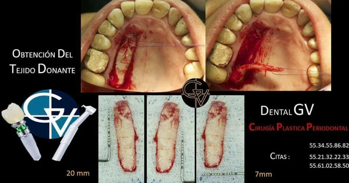 Dental GV