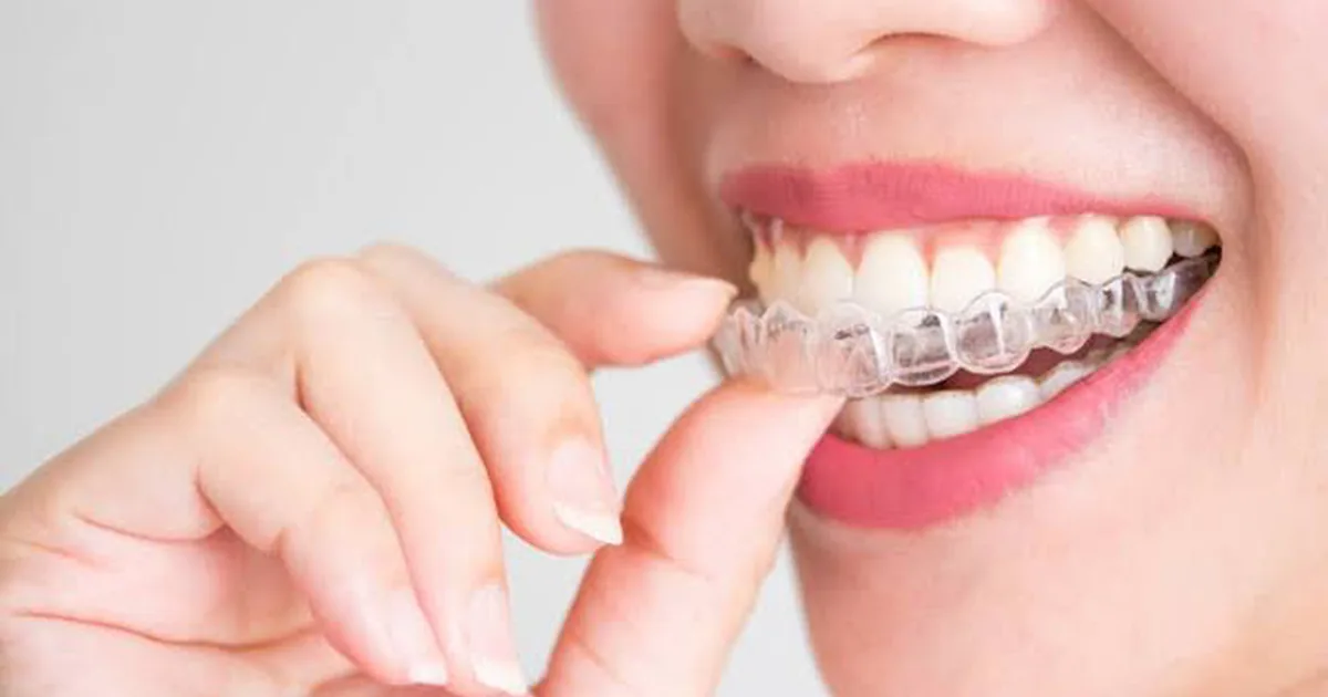 Clínica Dental SM – INVISALIGN PROVIDER (ORTODONCIA INVISIBLE)