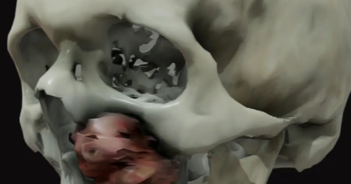 Dr Espiritu Santo – Prótesis Maxilofacial