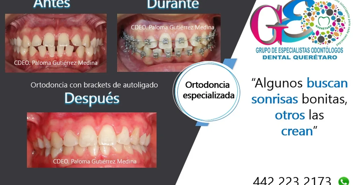 GEO Dental Querétaro – Ortodoncia, Endodoncia, Rehabilitación o Prótesis dental