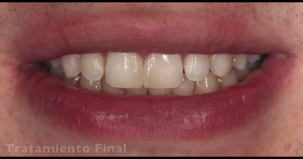 Implantes Dentales Pachuca