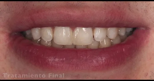 Implantes Dentales Pachuca, consultorio dental en Pachuca, Hidalgo