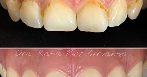 Implantes Dentales Morelia CÉNIT Odontología Avanzada | Dentistas en Morelia | Diseño de Sonrisa, consultorio dental en Morelia, Michoacán