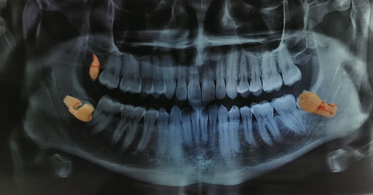 Dental TX