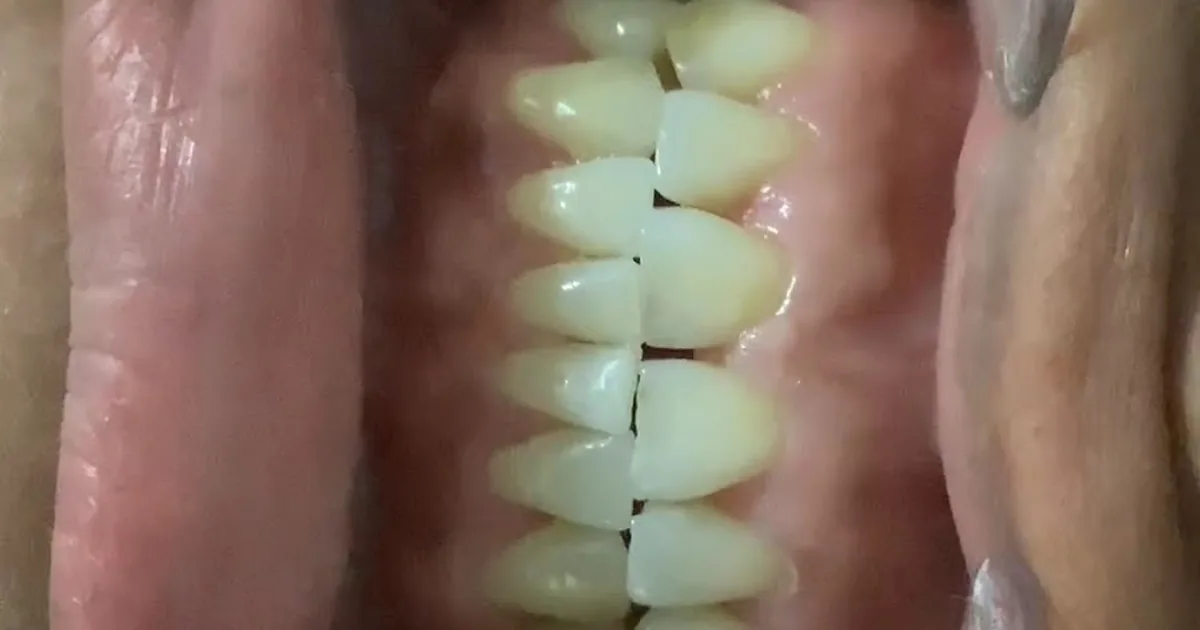 Dental García #carillas dentales